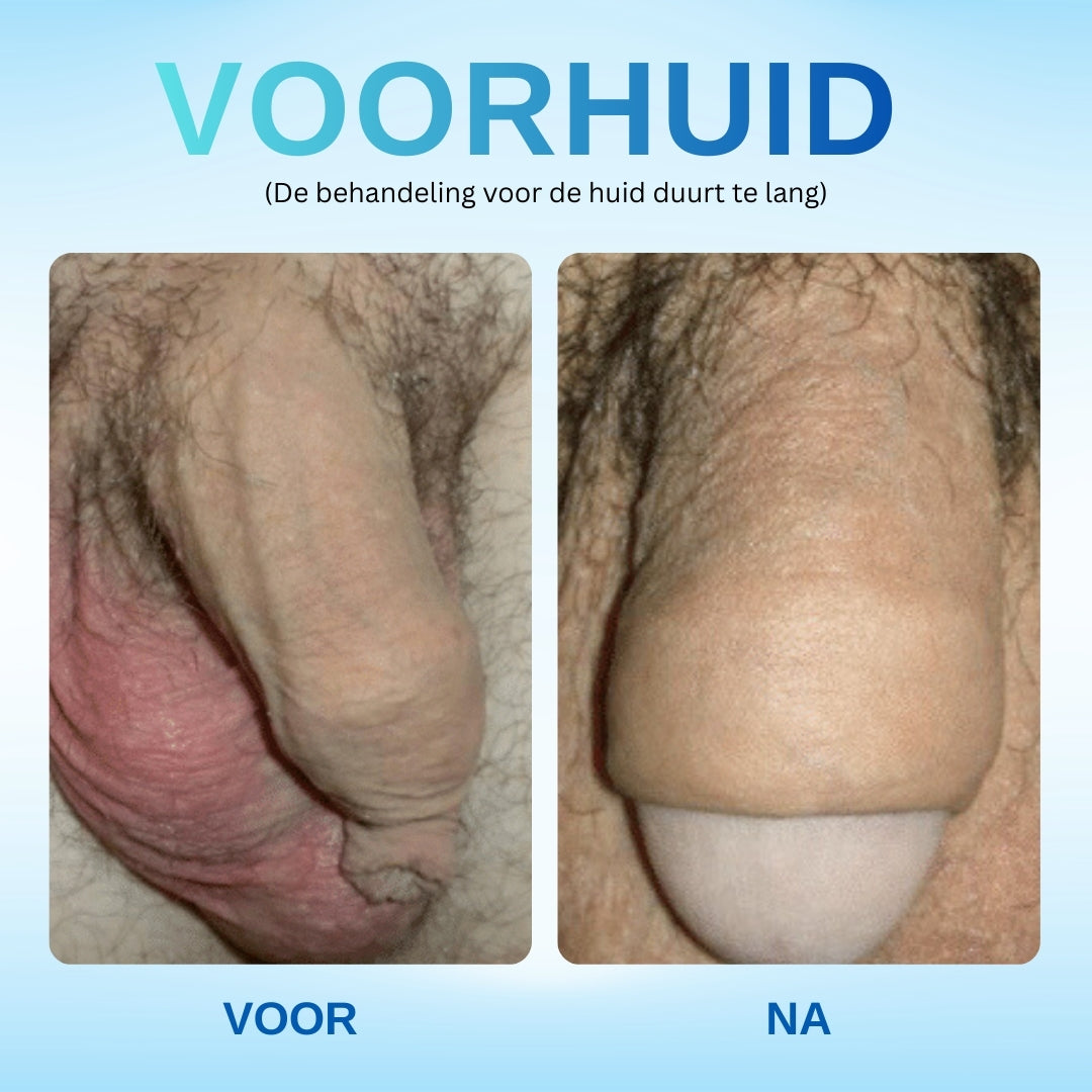🔥Nu 40% korting!-RZXEA™ Gel Tegen Overtollige Voorhuid