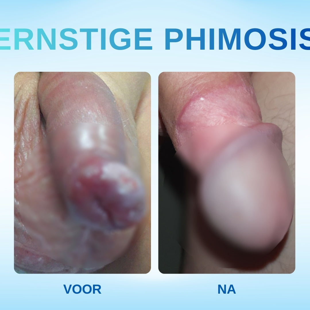🔥Nu 40% korting!-RZXEA™ Gel Tegen Overtollige Voorhuid