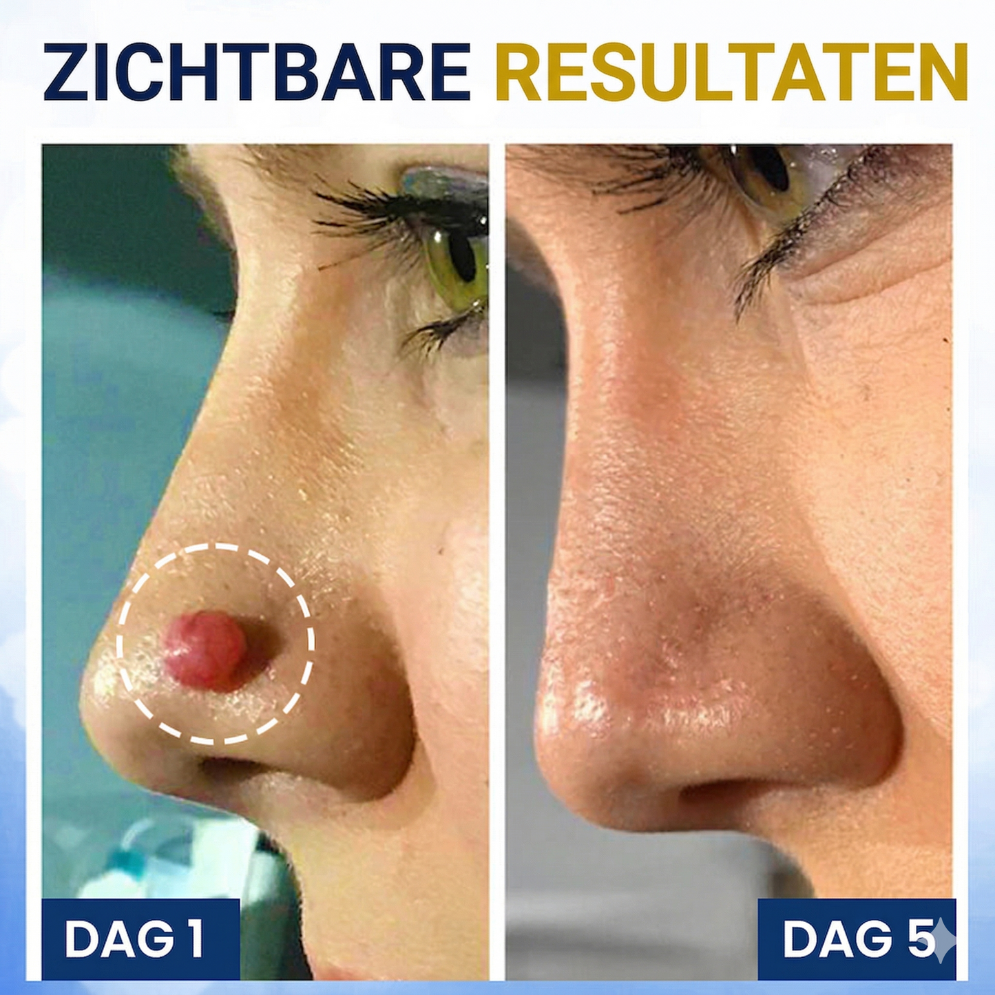 AEXZR ® Cryotherapie Spray voor Wratten en Skin Tags: Verwijder wratten en steelwratjes snel en pijnloos – resultaat binnen 7 dagen! 🚀